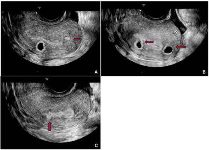 What is hypoechoic pregnancy