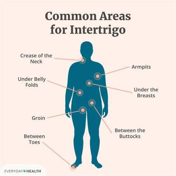 What is intertrigo caused by