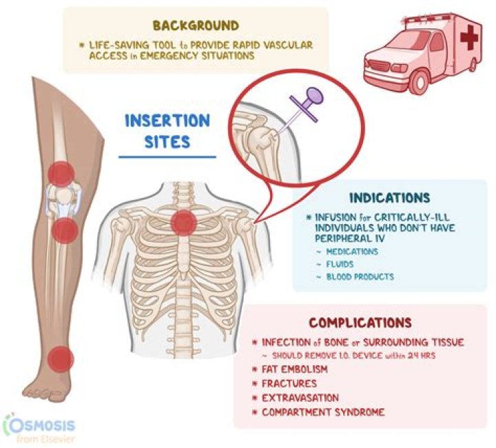 What is intraosseous cannula