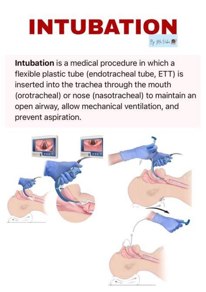 What is intubation procedure