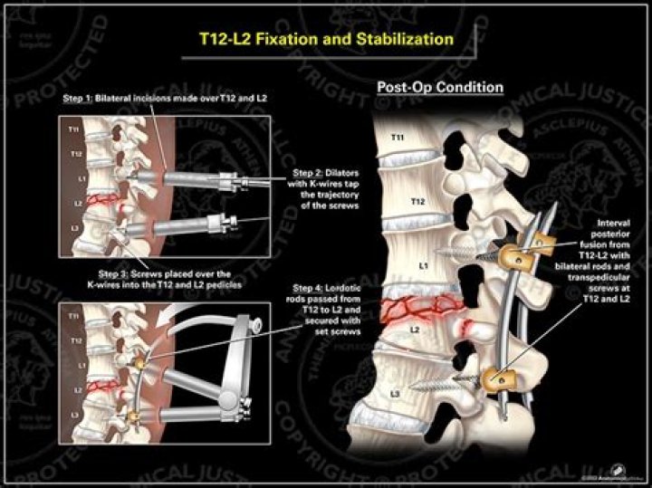 What is lumbar Stabilisation