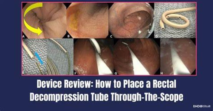 What is rectal decompression