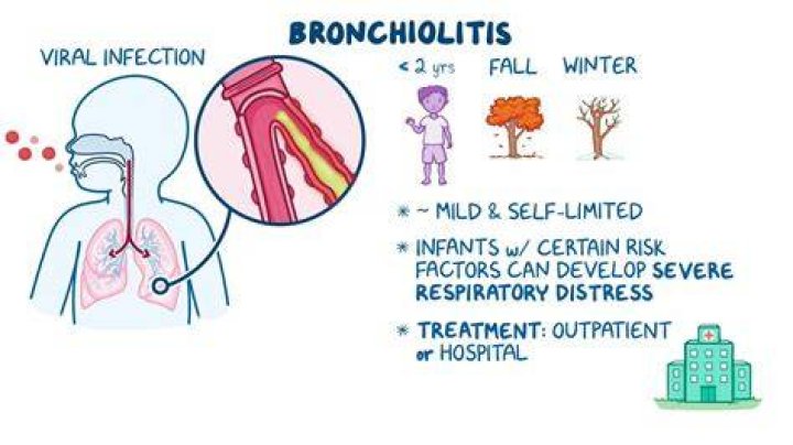 What is severe bronchiolitis