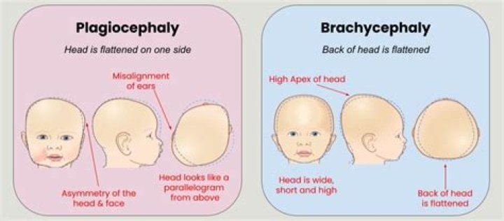 What is severe plagiocephaly
