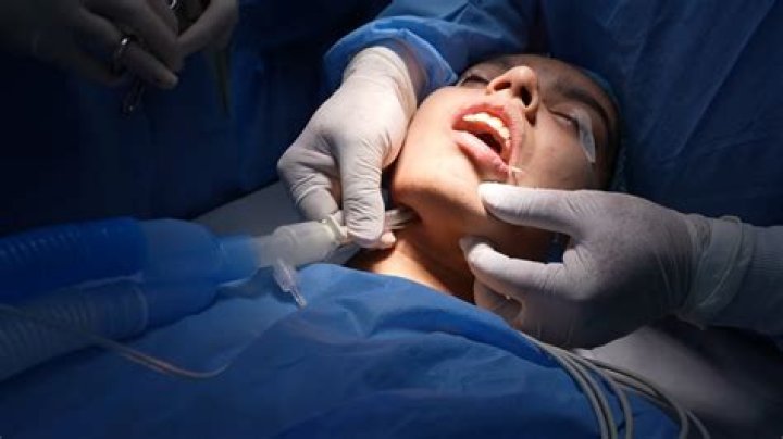 What is submental intubation