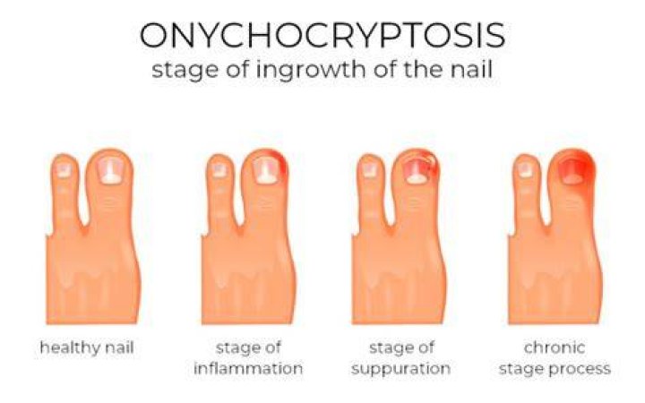 What is the onychocryptosis