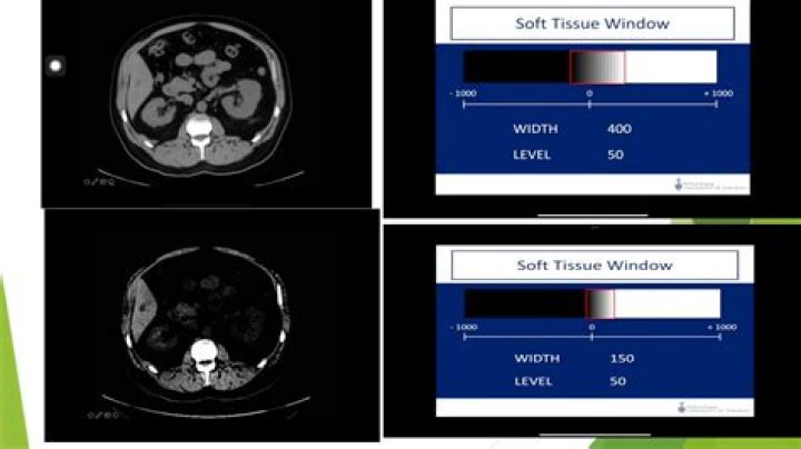What is windowing in CT scan