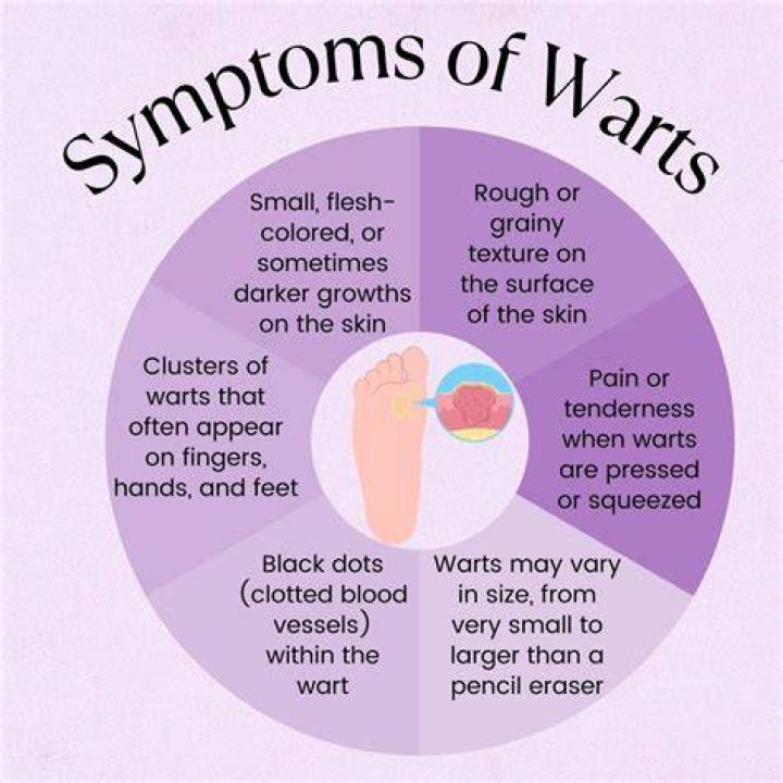 What kills a wart instantly