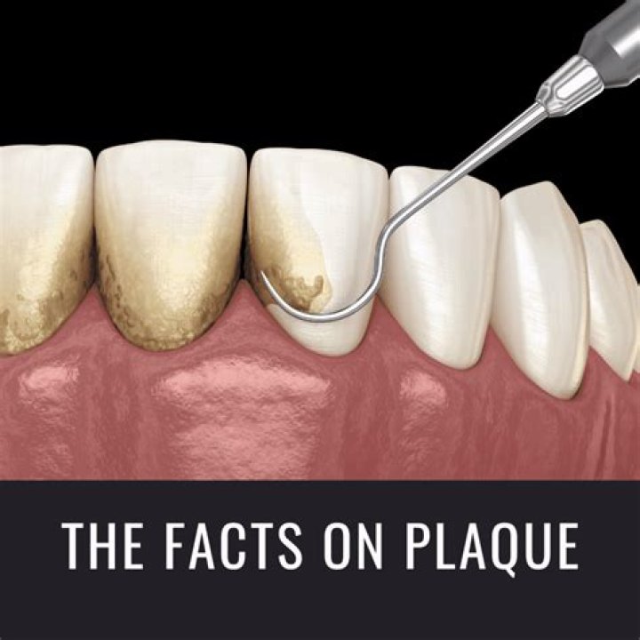 What makes a plaque unstable