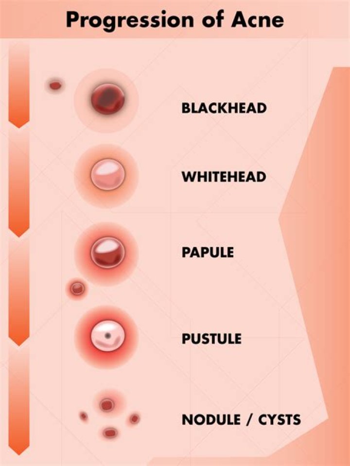 What STD looks like a pimple