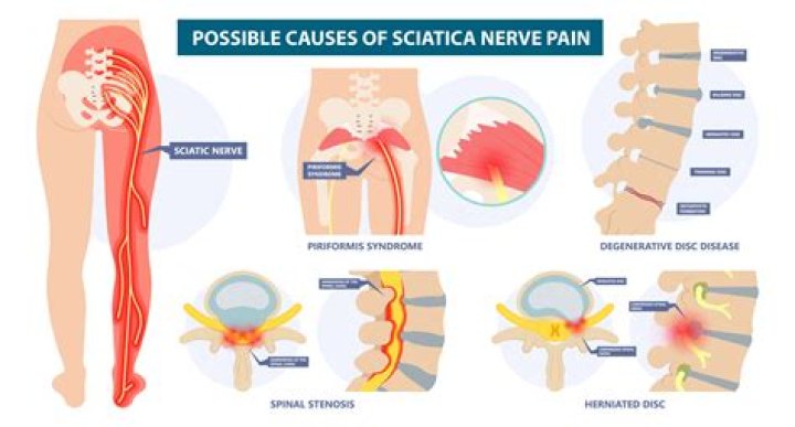 What tests are done to diagnose sciatica
