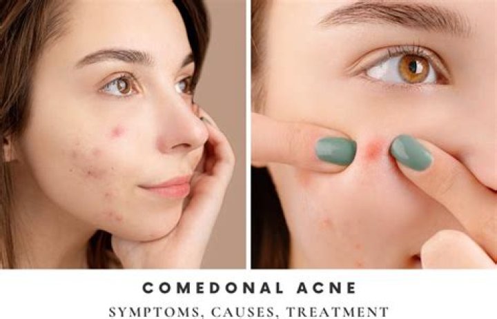What triggers comedonal acne