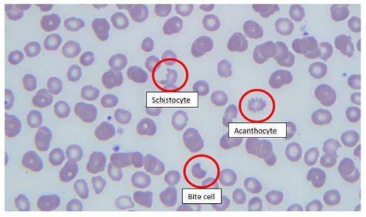 When do you see schistocytes