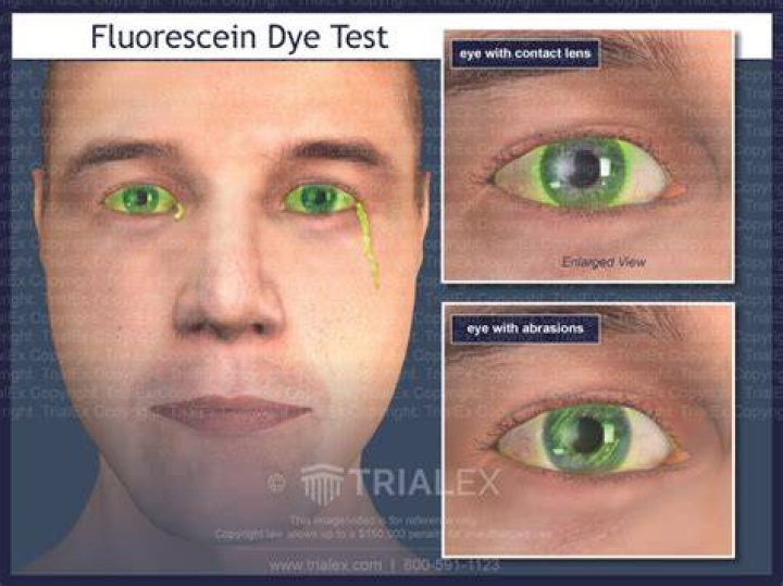When do you use fluorescein