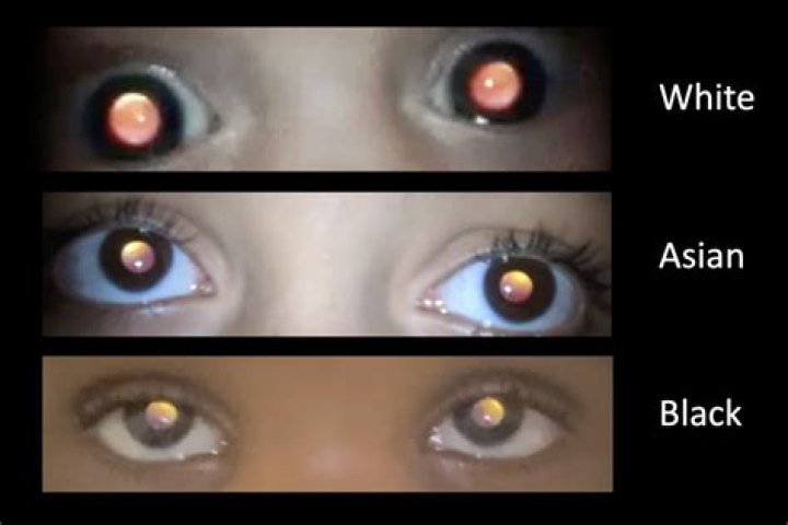 When does red reflex appear