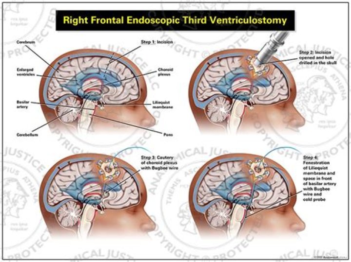 Who needs a ventriculostomy