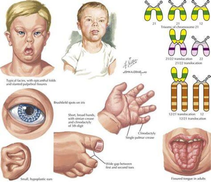 Why is it called trisomy 21