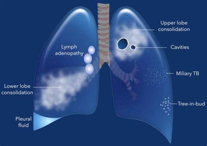 Why is TB in the upper lobes