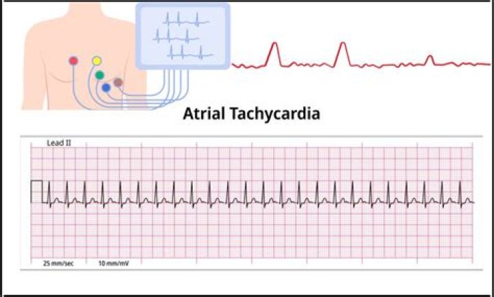 Why would a patient be Tachycardic
