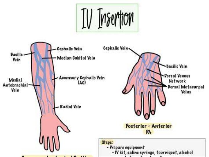 Why would someone need an IV