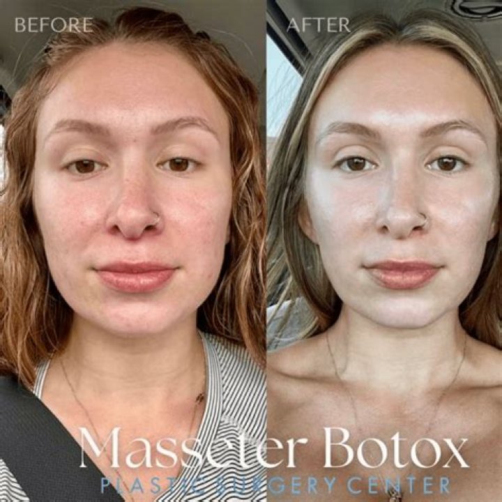 Will Botox ever get cheaper